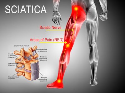 sciatica-pain